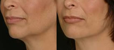 botox_nefertiti-prin-meta