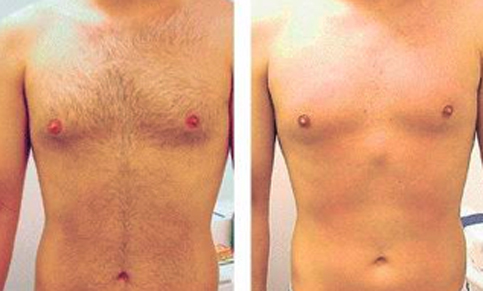 laser_apotrixosi_body-prin-meta